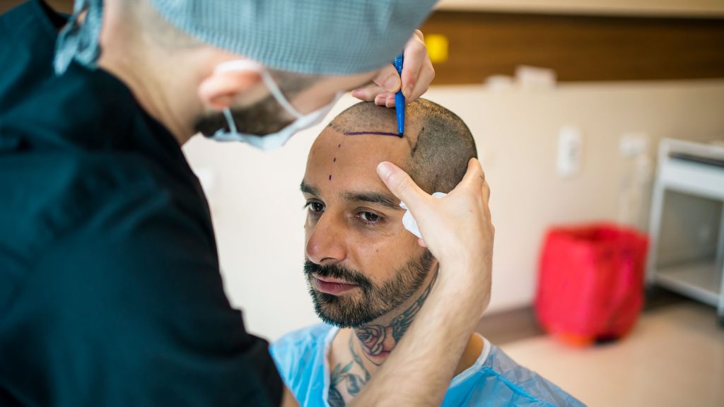 man_hair_transplant_preparation-1277525831