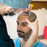 Hair Transplant: What Makes Westminster Medical Group Unique